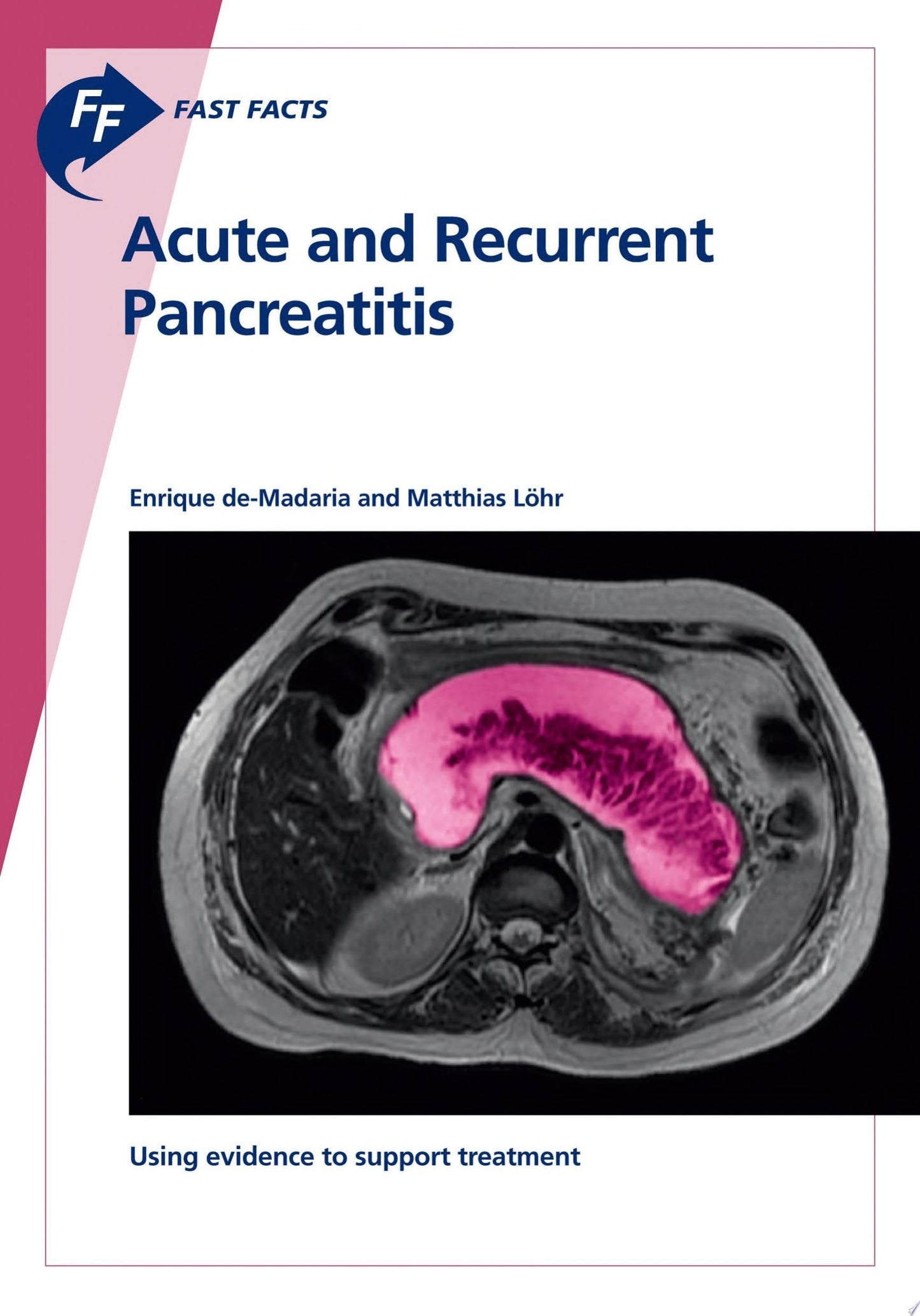 Fast Facts: Acute and Recurrent Pancreatitis