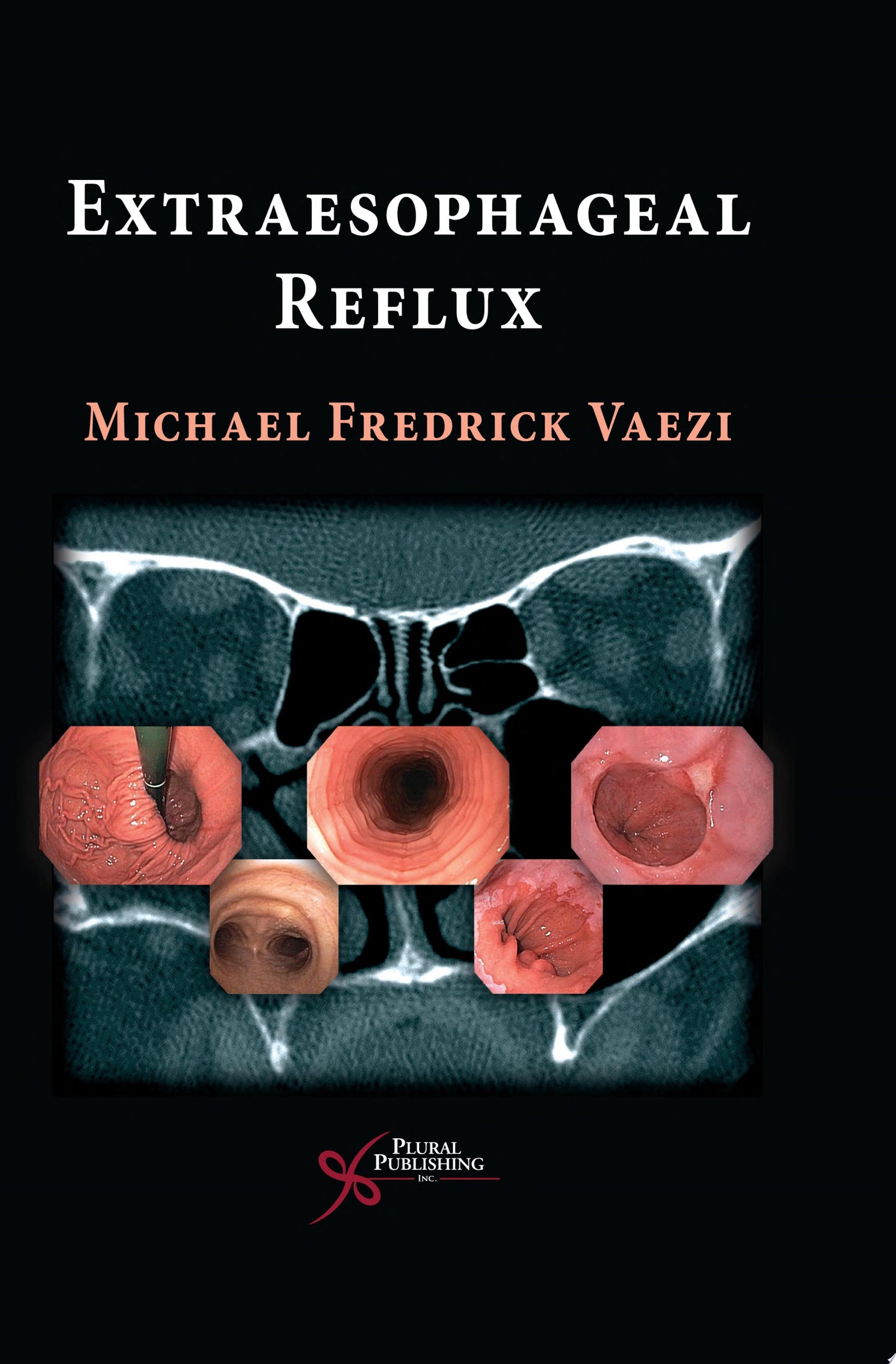 Extraesophageal Manifestations of GERD