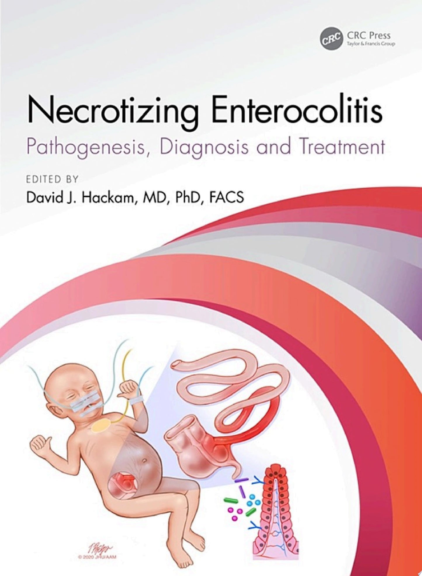 Necrotizing Enterocolitis: pathogenesis, diagnosis and treatment